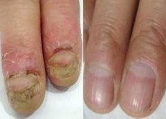 灰指甲治疗前后对比