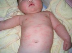 儿童荨麻疹的表现症状