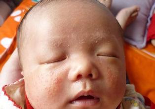 婴儿湿疹护理方法