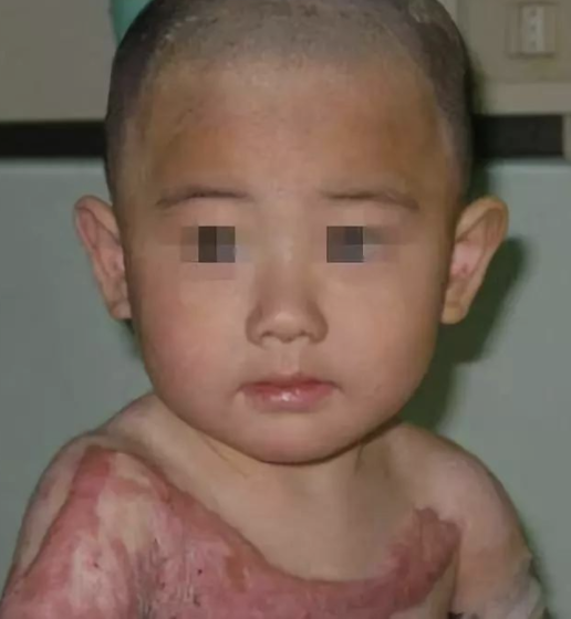 小孩子的脸上有增生怎么办